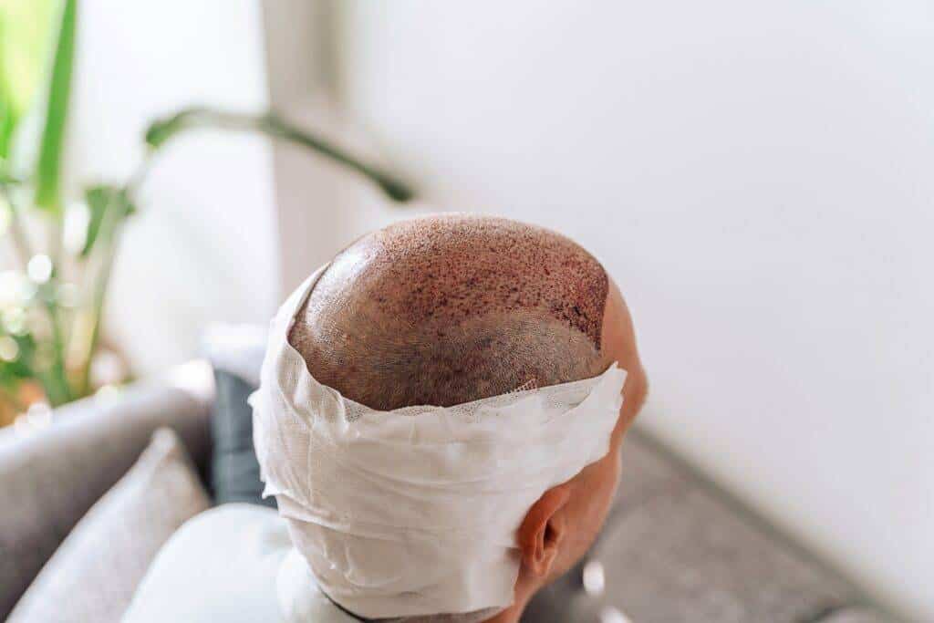 תקריב של ראש של אדם שעבר השתלת שיער